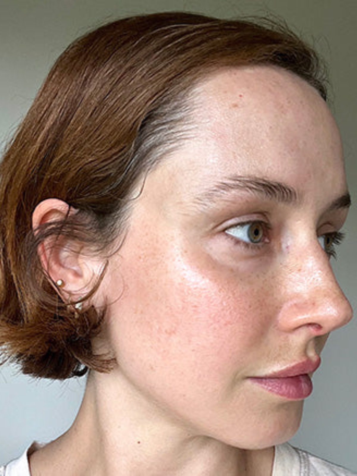 Hyperpigmentation