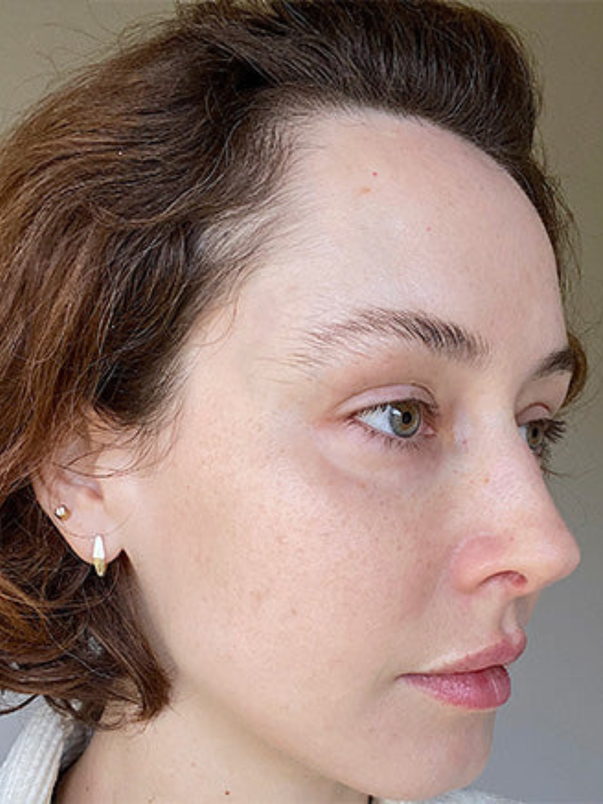Hyperpigmentation